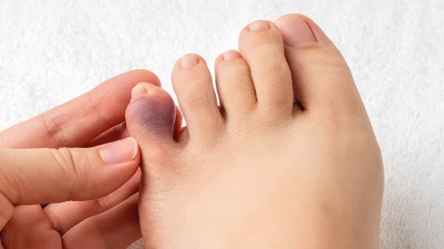 Những triệu chứng tiềm ẩn của loét bàn chân đái tháo đường cần đặc biệt lưu ý!